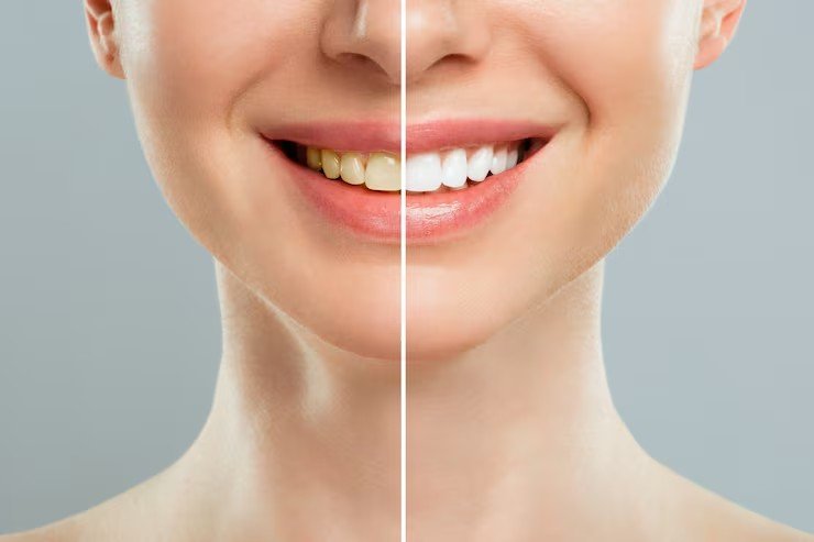 Procedimento de clareamento dentário
